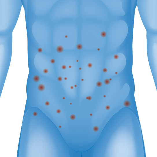 Hypersensitivity reaction