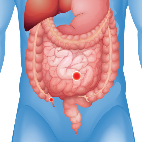 Intestinal blockage