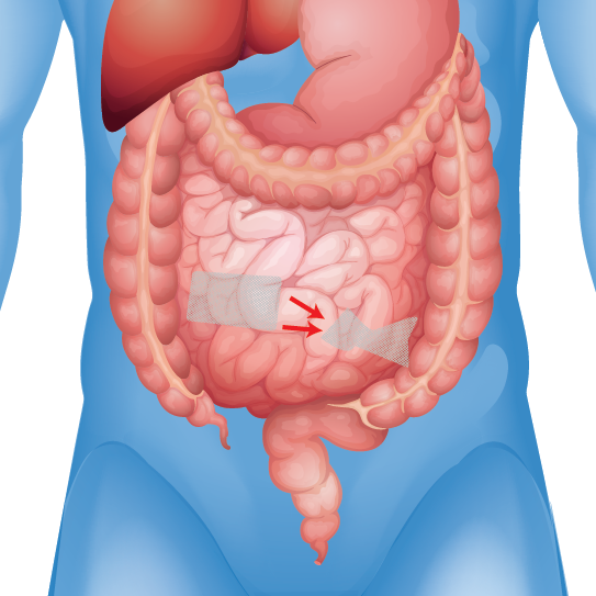 Erosion in intestine