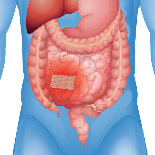 Foreign body inside of intestine