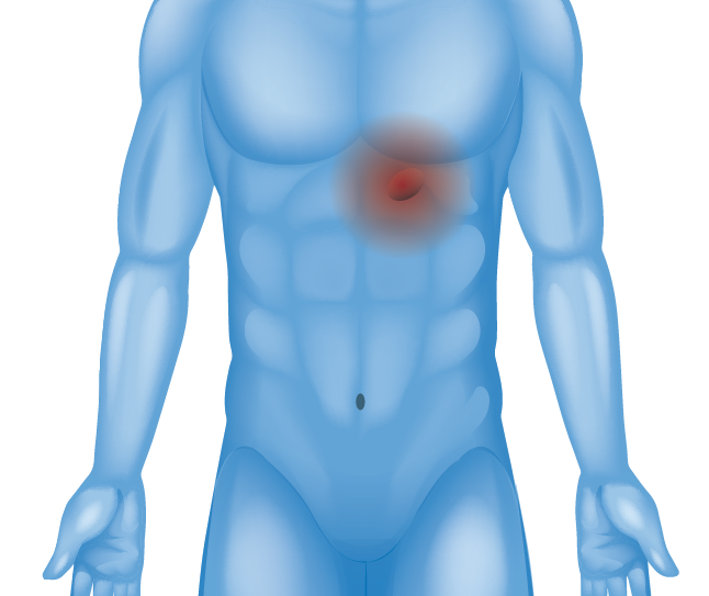 Hernia in lower chest