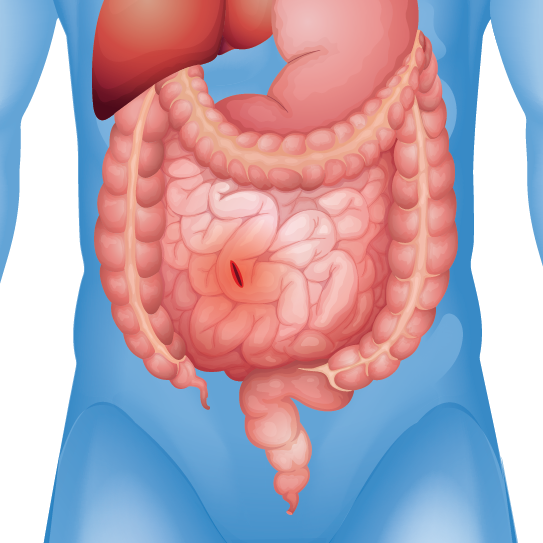 Perforation in intestine