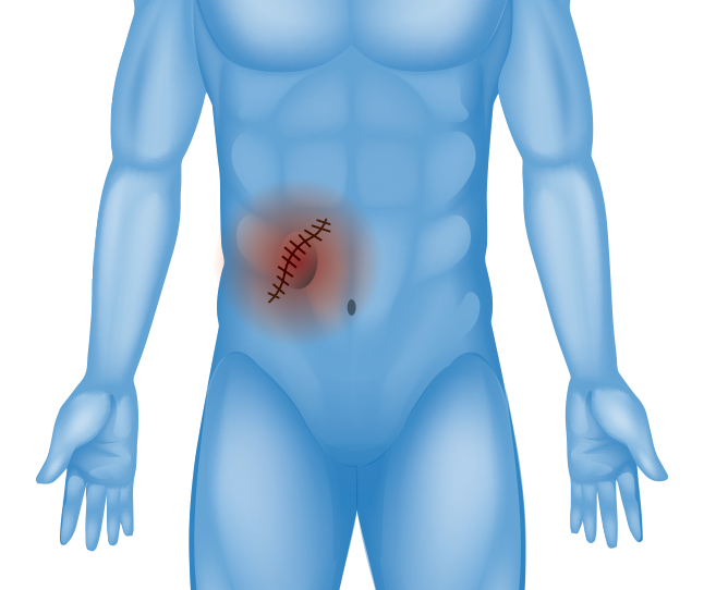 Abdominal scar illustration