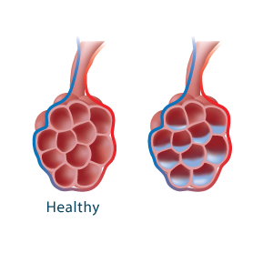 Alveoli with accumulated fluid