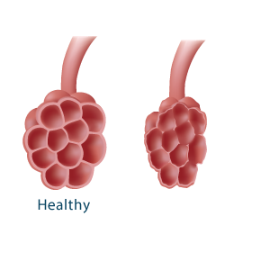 Healthy and unhealthy alveoli