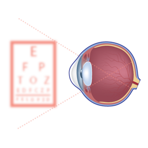 Impaired vision diagram