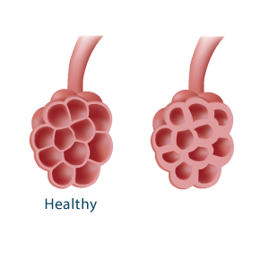 Illustration of a healthy and unhealthy alveoli